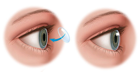 Keratoplasty