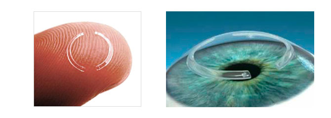 intacs for keratoconus