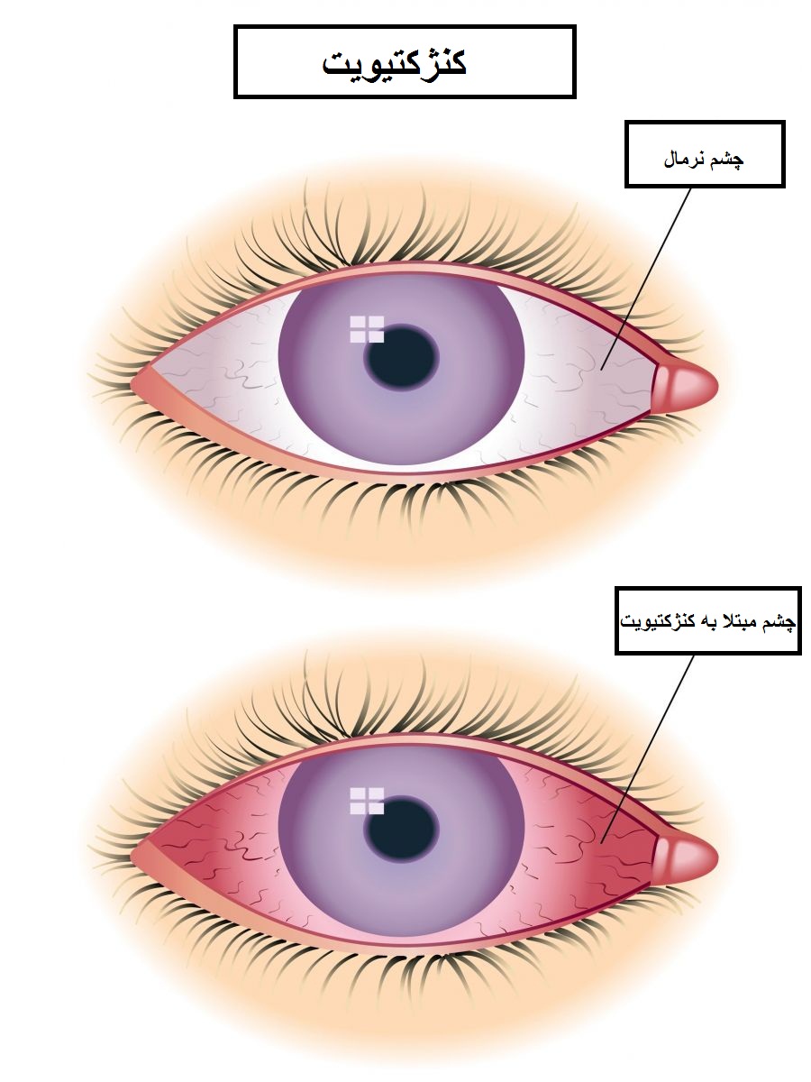Conjunctivitis.sedaghat eye clinic.jpg1.jpg3