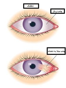 Pterygium Surgerysedaghat eye clinic..jpg1