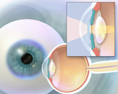 phakic IOL.sedaghat eye surgery.jpg